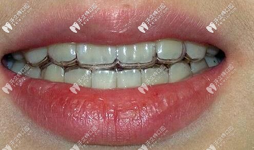 無錫美奧口腔顧客戴隱形牙套口內(nèi)照片