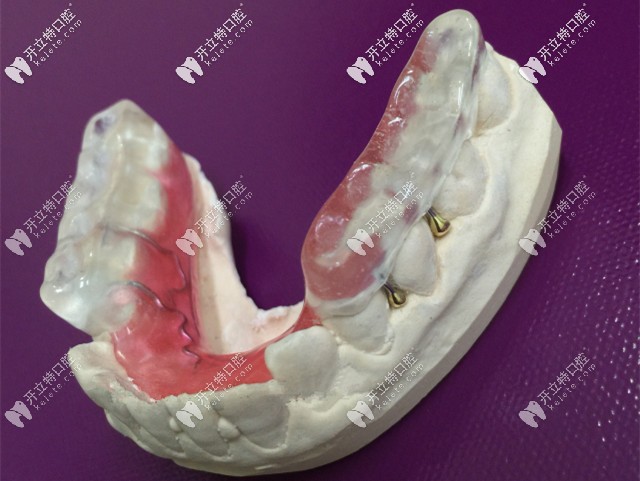 后牙做頜墊打開(kāi)咬合