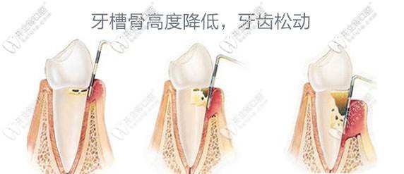 牙周炎會導(dǎo)致牙齒松動