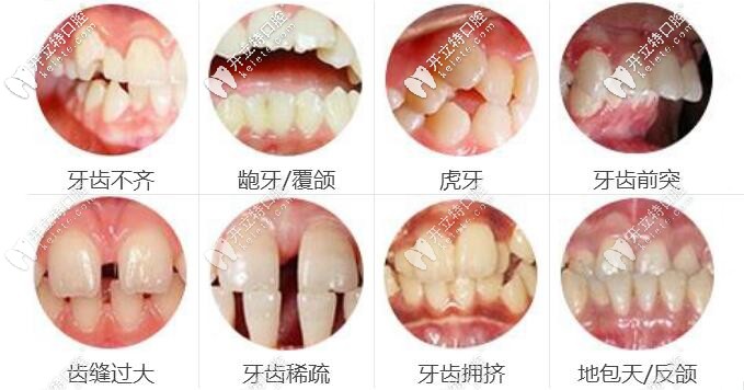 牙齒矯正適應(yīng)癥