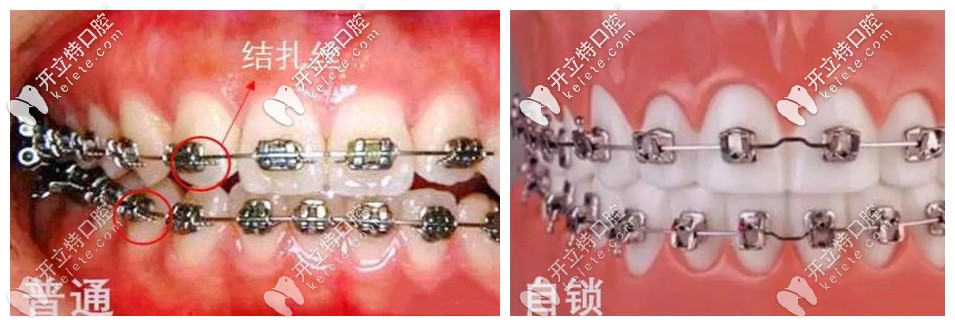 統(tǒng)金屬牙套和金屬自鎖區(qū)別