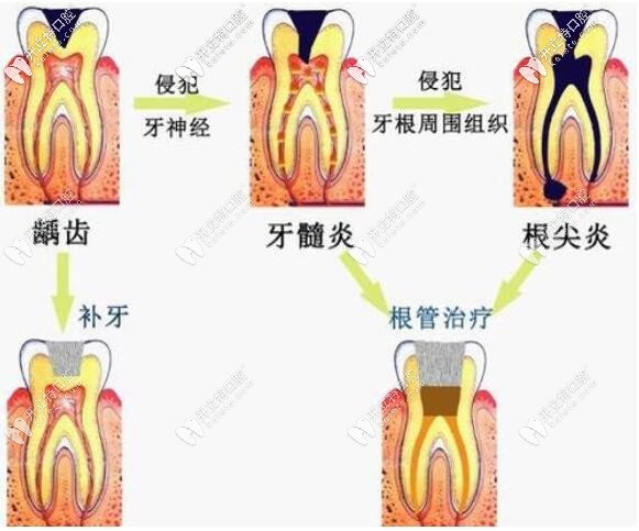 齲齒的發(fā)展過程及治療
