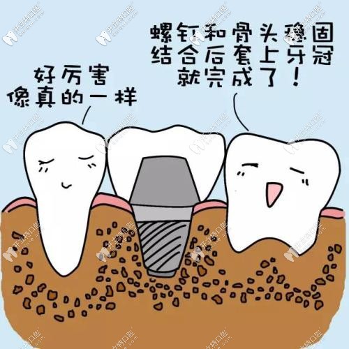種植牙的過程