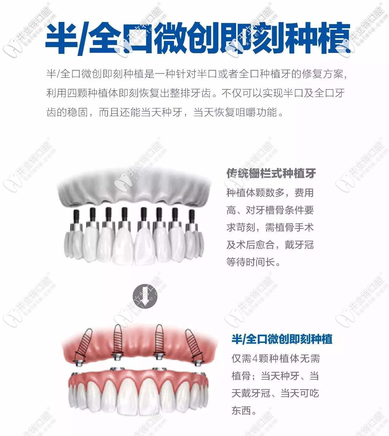 即刻種植和傳統(tǒng)種植對比