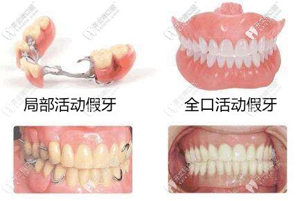 全口活動(dòng)假牙和半口活動(dòng)假牙
