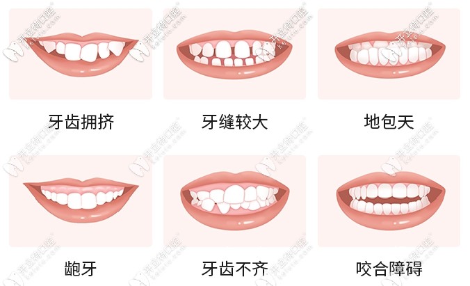 牙齒矯正適應(yīng)癥