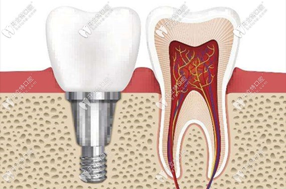 種植牙的費用主要包含種植體、牙冠這兩大塊