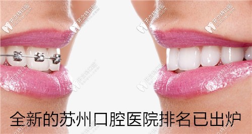 蘇州口腔醫(yī)院排名已發(fā)布！快來(lái)看蘇州哪家牙科便宜又好