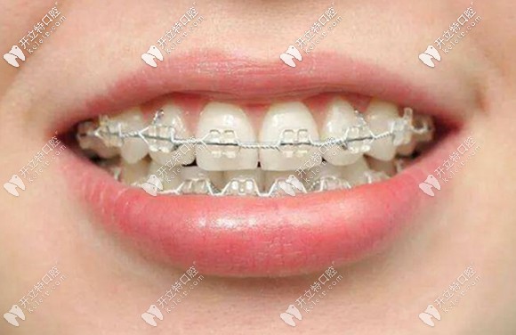 蘇州矯正牙齒的費(fèi)用大概多少錢呢