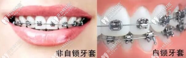自鎖和非自鎖牙套區(qū)別