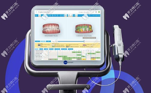 Itero口內(nèi)掃描儀