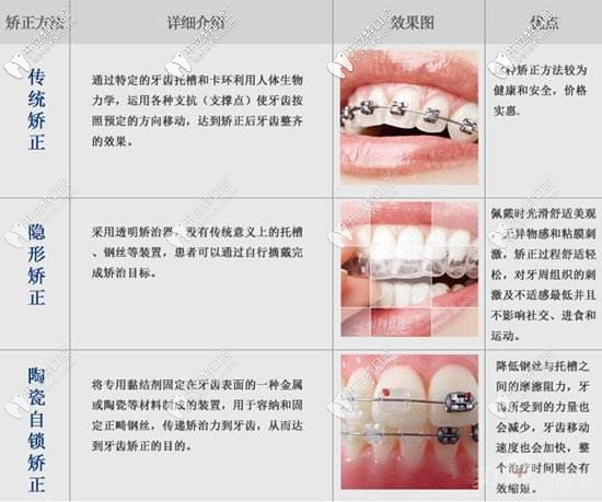 牙齒矯正的各種方式