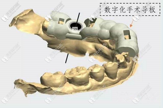 數(shù)字化種植技術(shù)中的導(dǎo)板