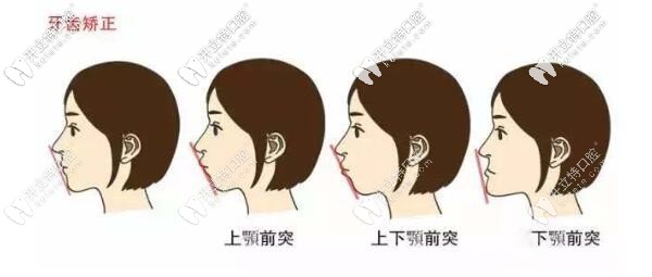 牙齒矯正后的變化