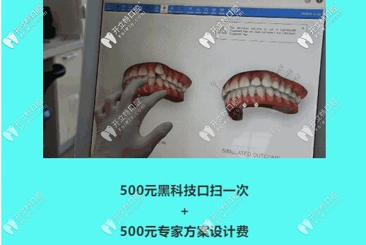 中山好民生口腔口掃體驗(yàn)