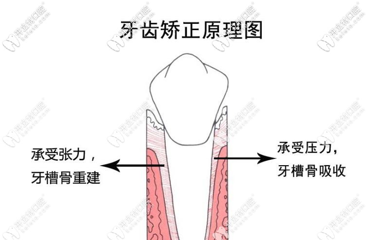 牙齒矯正原理圖