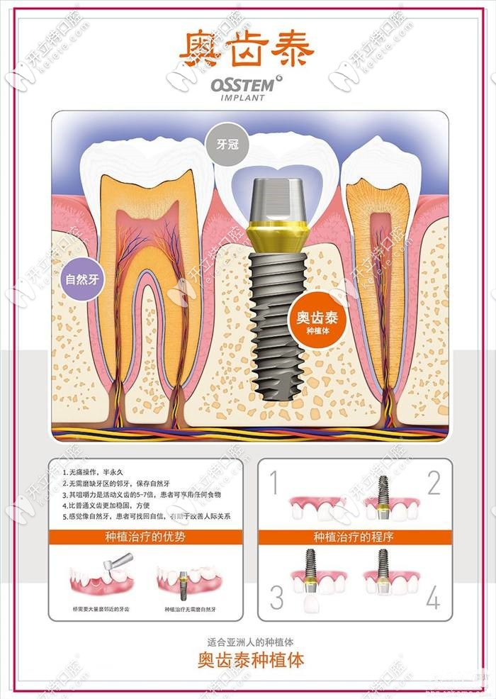 韓國(guó)奧齒泰種植牙的優(yōu)勢(shì)
