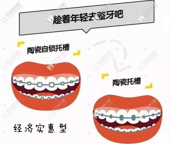 經(jīng)濟(jì)實(shí)惠型—陶瓷自鎖托槽