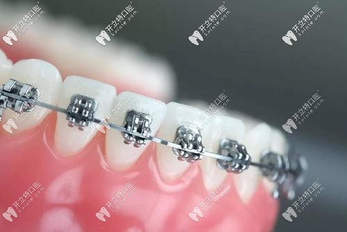 金屬托槽矯正外觀(guān)