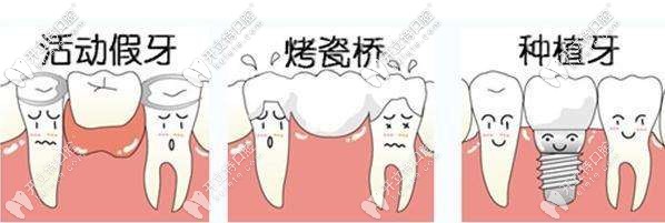 鑲牙分為活動假牙、烤瓷牙及種植牙
