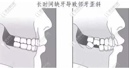缺牙不種的危害