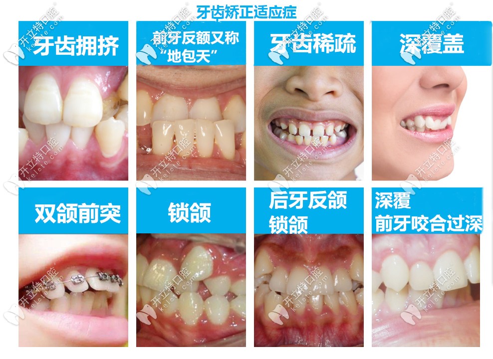 牙齒不齊的類(lèi)型