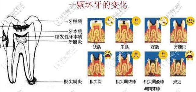 一顆壞牙的變化齲壞治療