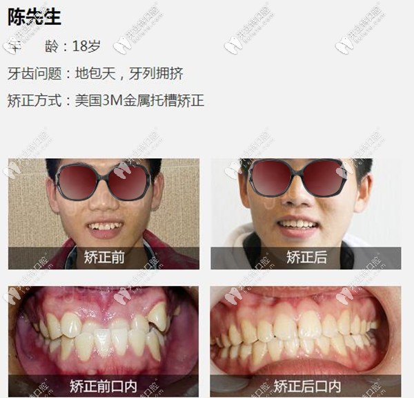 深圳格倫菲爾口腔地包天牙齒矯正案例