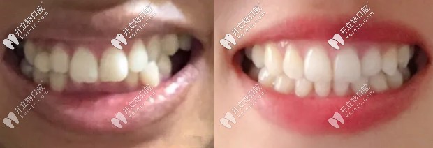 40歲矯正牙齒經(jīng)歷:重度深覆合摘下自鎖牙套后笑起來(lái)很迷人