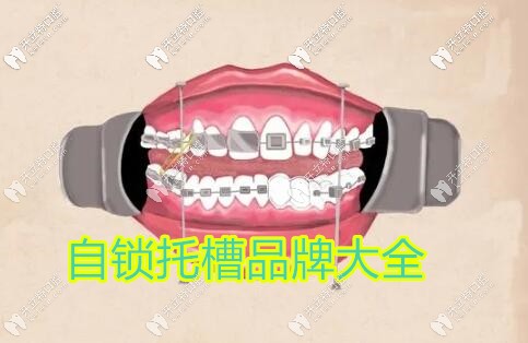 金屬自鎖牙套品牌大全匯總,說(shuō)說(shuō)國(guó)產(chǎn)和進(jìn)口到底有啥區(qū)別？