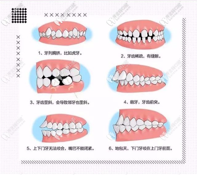 牙齒不齊的類(lèi)型及危害