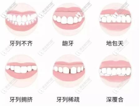 牙齒畸形表現(xiàn)