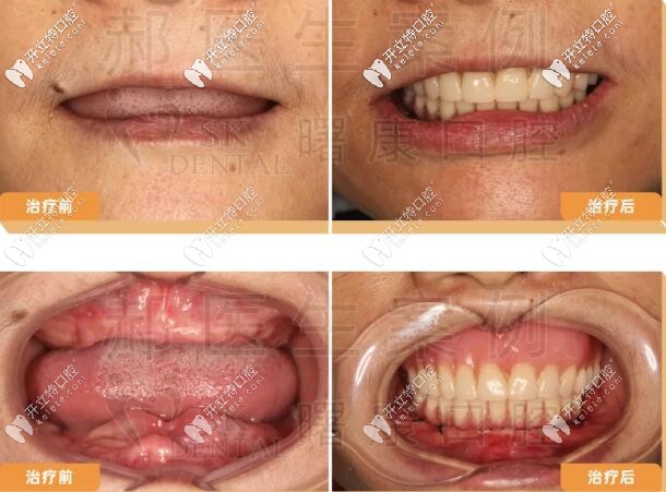 <!--<i data=20240703-sp></i>-->曙康口腔全口種植牙案例前后對(duì)比圖