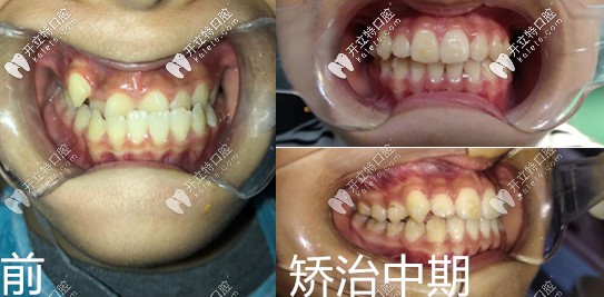 <!--<i data=20240703-sp></i>-->口腔醫(yī)院兒童地包天矯正真人案例 <!--<i data=20240703-sp></i>-->口腔醫(yī)院兒童地包天矯正真人案例