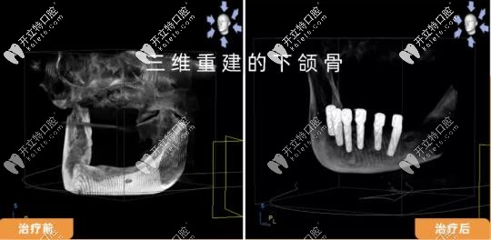 <!--<i data=20240703-sp></i>-->曙康全口all-on-6種植x線片前后對(duì)比