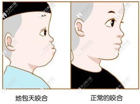 地包天和正常咬合圖片 地包天和正常咬合圖片