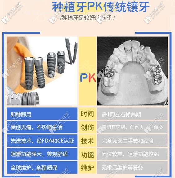 種植牙和傳統(tǒng)假牙哪個(gè)好