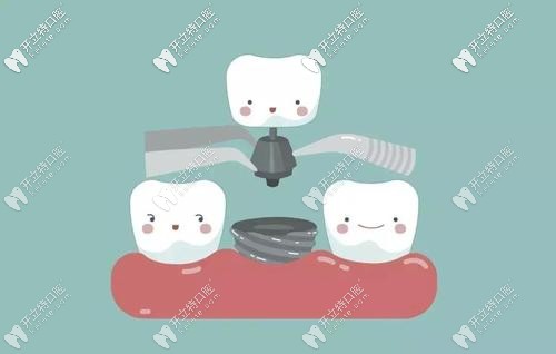 想在天津市做全口種植牙必看,費(fèi)用貴不貴自己體會(huì)喲~