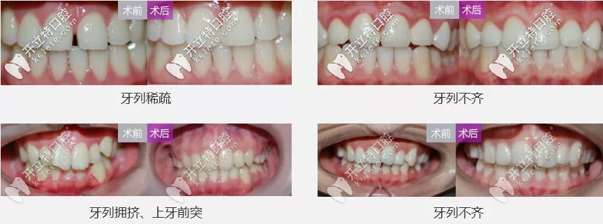 <!--<i data=20240703-sp></i>-->自鎖托槽矯正案例