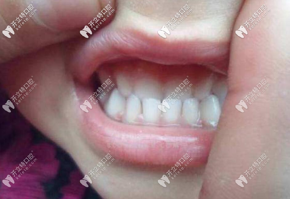 正畸較快多久能摘牙套？需要等到什么程度才可以取下