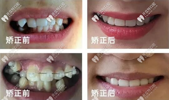 蘭州皓亞口腔正畸案例前后對(duì)比圖