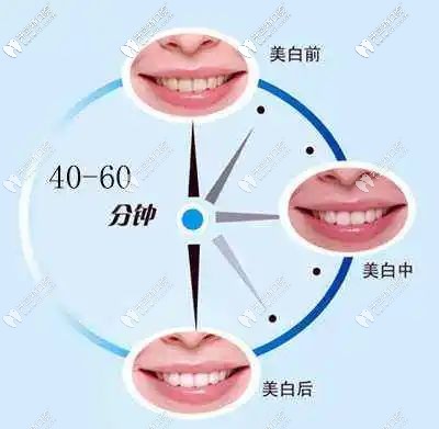 冷光美白維持時(shí)間