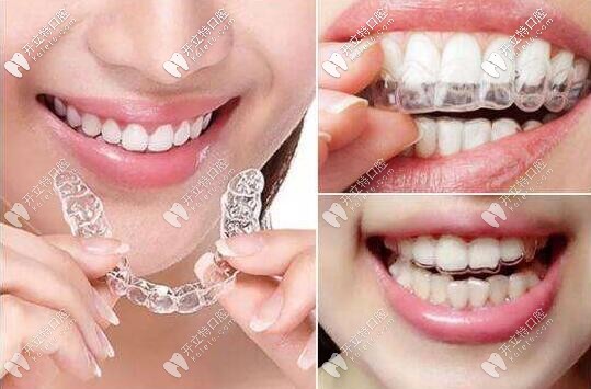 全隱形無(wú)托槽矯治器