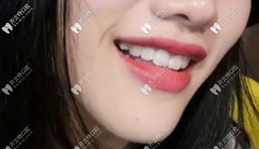 戴了保持器的我美不美