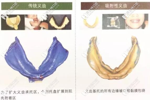 全口生物功能吸附性義齒和普通假牙的區(qū)別