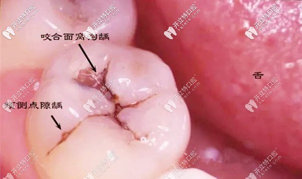 牙齒表面有黑點(diǎn)就是蛀牙哦,此時(shí)補(bǔ)牙能省很多錢(qián)呢！