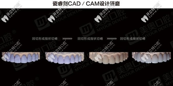 瓷?？藽AD/CAM設(shè)計