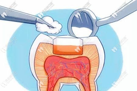 牙齒齲壞要及時(shí)修復(fù)