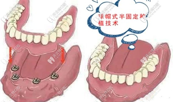 深圳爾睦口腔半口半固定種植牙