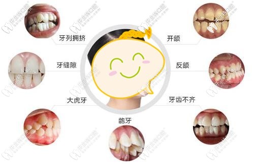 廣州廣大口腔牙齒矯正活動價